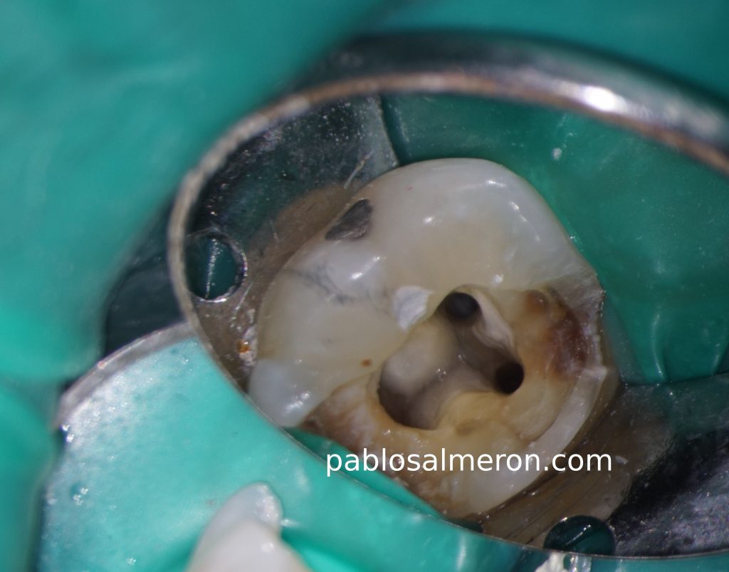 first molar pulp chamber
