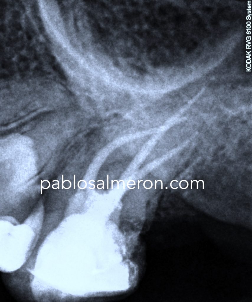 upper second molar root canal treatment